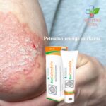 Biocalendula neven krem protiv psorijaze, ekcema, dermatitisa 50ml