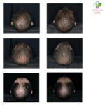 Revitabion R10000 sprej protiv opadanja kose 200ml