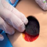 Acticoat Flex 3 antimikrobna obloga za rane 10cm x 10cm 1 komad