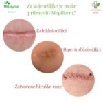 Mepiform flaster protiv ožiljaka 10cm x 18cm 1 komad