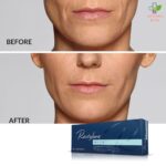 Restylane Defyne filer za popunjavanje dubokih bora 1ml