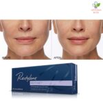 Restylane Refyne filer za bore oko usana, čela i oko očiju 1ml