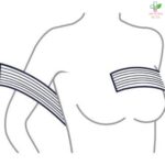 Post-op Implant stabilizer band-traka za stabilizaciju impanta nakon uvećanja grudi