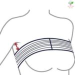 Post-op Implant stabilizer band-traka za stabilizaciju impanta nakon uvećanja grudi